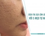 Cách trị sẹo lõm lâu năm không khó với 5 mẹo tự nhiên này